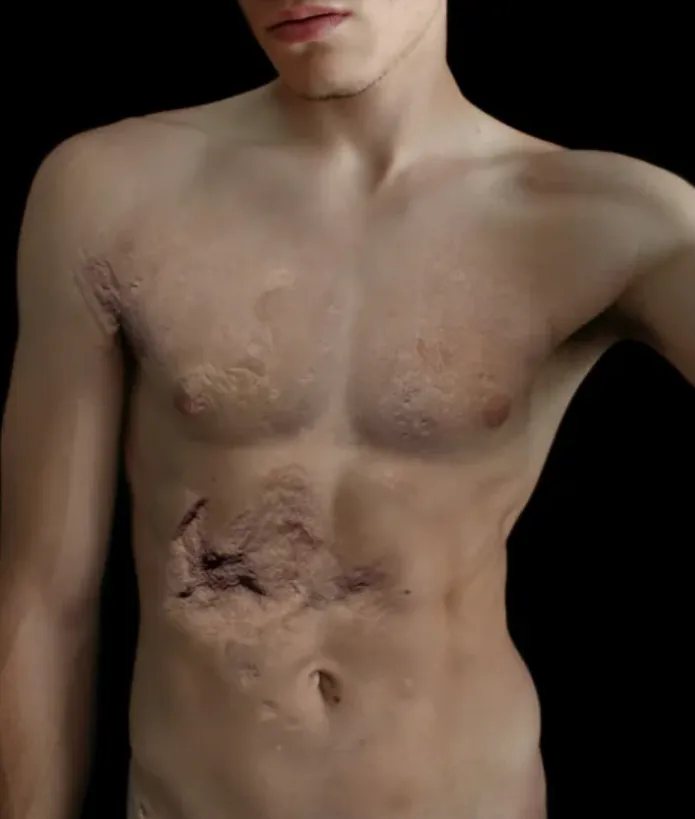 Torso humano con cicatrices y alteraciones cutáneas, obra de Victoria Diehl.